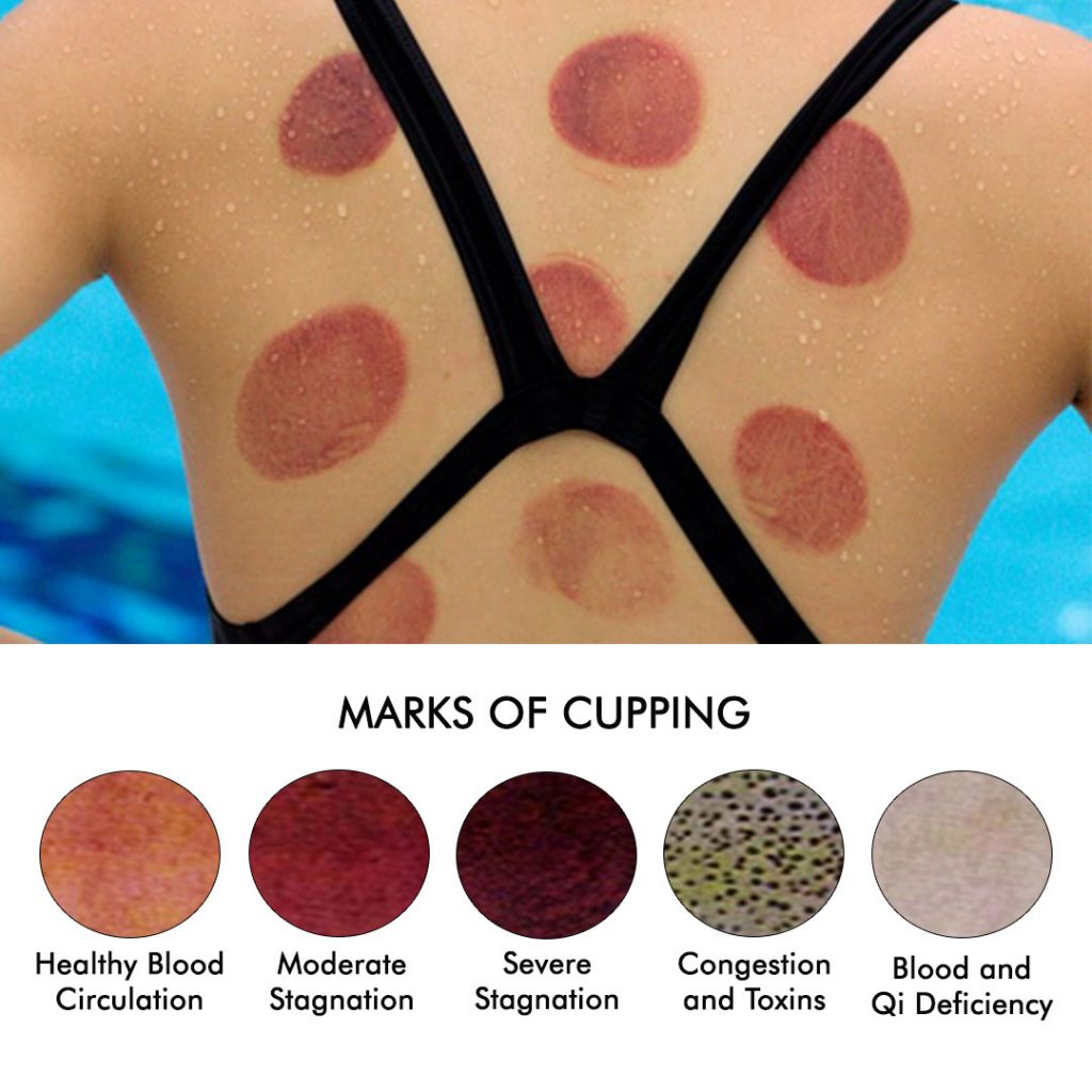 cupping-marks